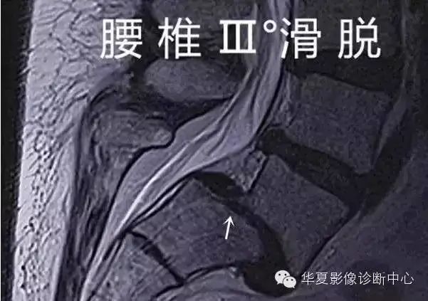 影像PPT - 容易忽略的十个腰椎MRI的征象-28 影像PPT - 容易忽略的十个腰椎MRI的征象-28