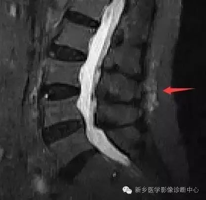 影像PPT - 容易忽略的十个腰椎MRI的征象-30 影像PPT - 容易忽略的十个腰椎MRI的征象-30