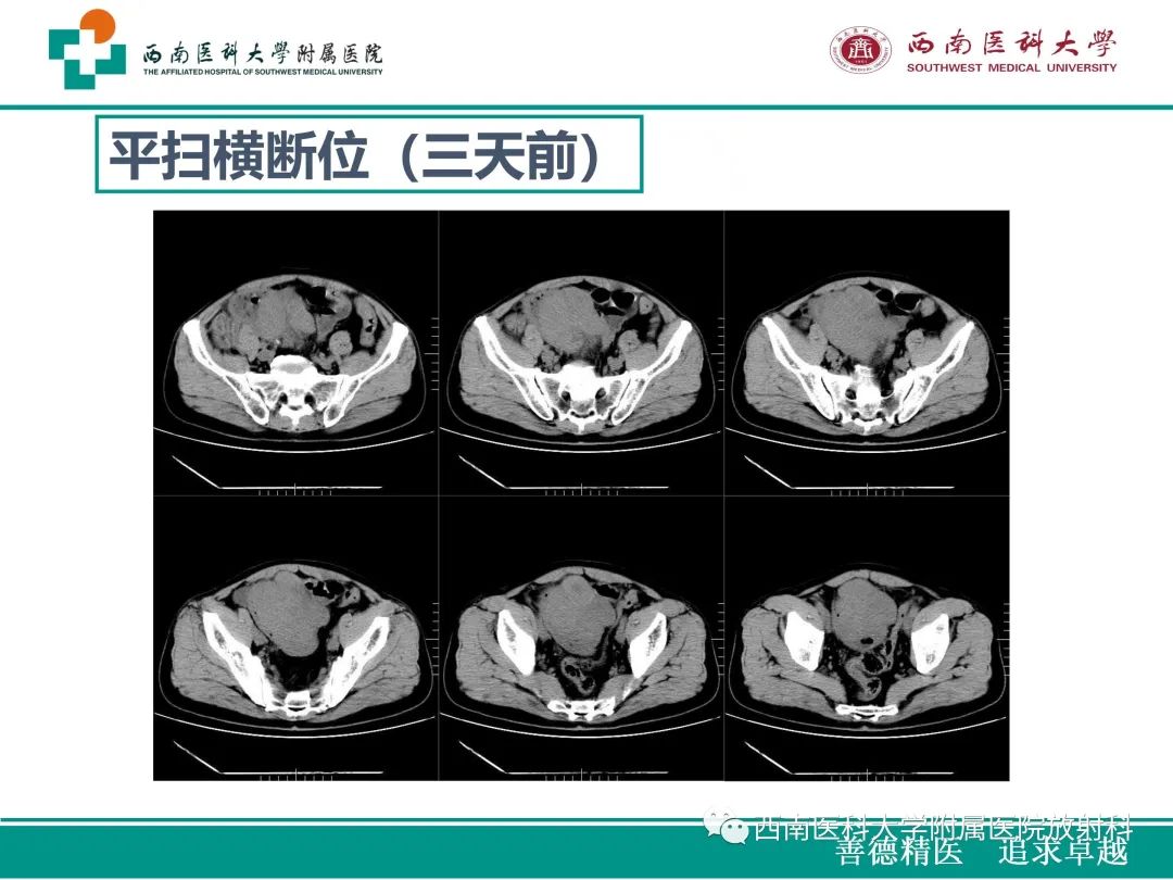 影像PPT - 【病例】原发性消化道恶性黑色素瘤1例CT影像-4