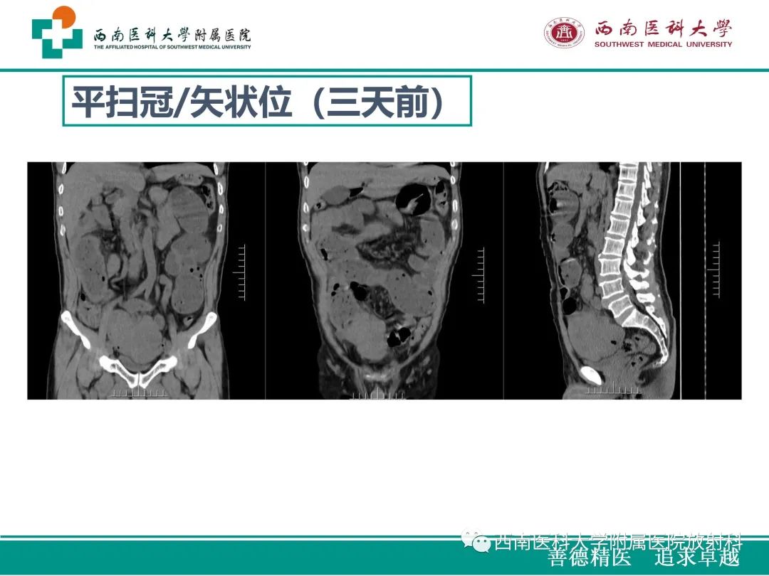 影像PPT - 【病例】原发性消化道恶性黑色素瘤1例CT影像-5
