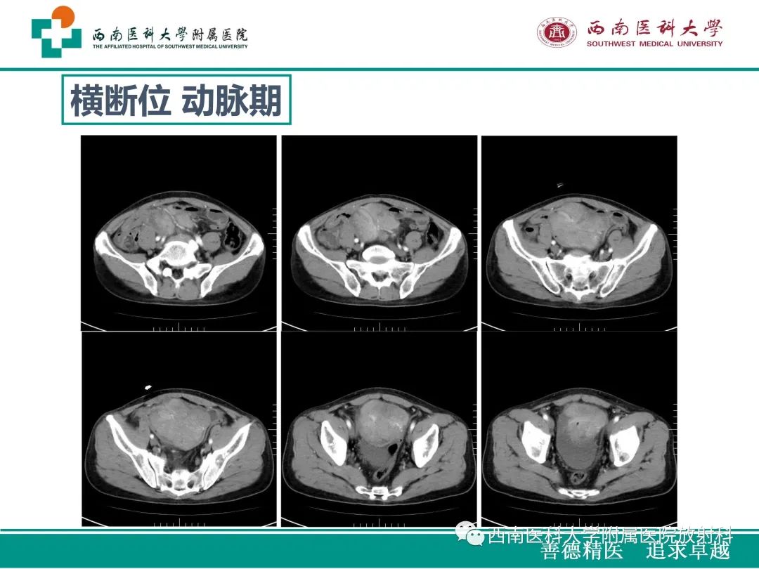 影像PPT - 【病例】原发性消化道恶性黑色素瘤1例CT影像-6