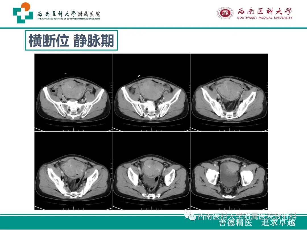 影像PPT - 【病例】原发性消化道恶性黑色素瘤1例CT影像-7
