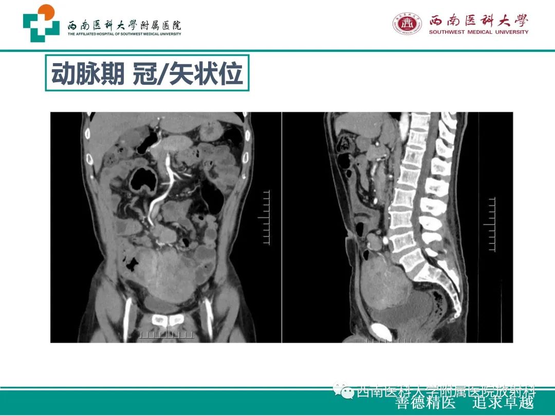 影像PPT - 【病例】原发性消化道恶性黑色素瘤1例CT影像-8