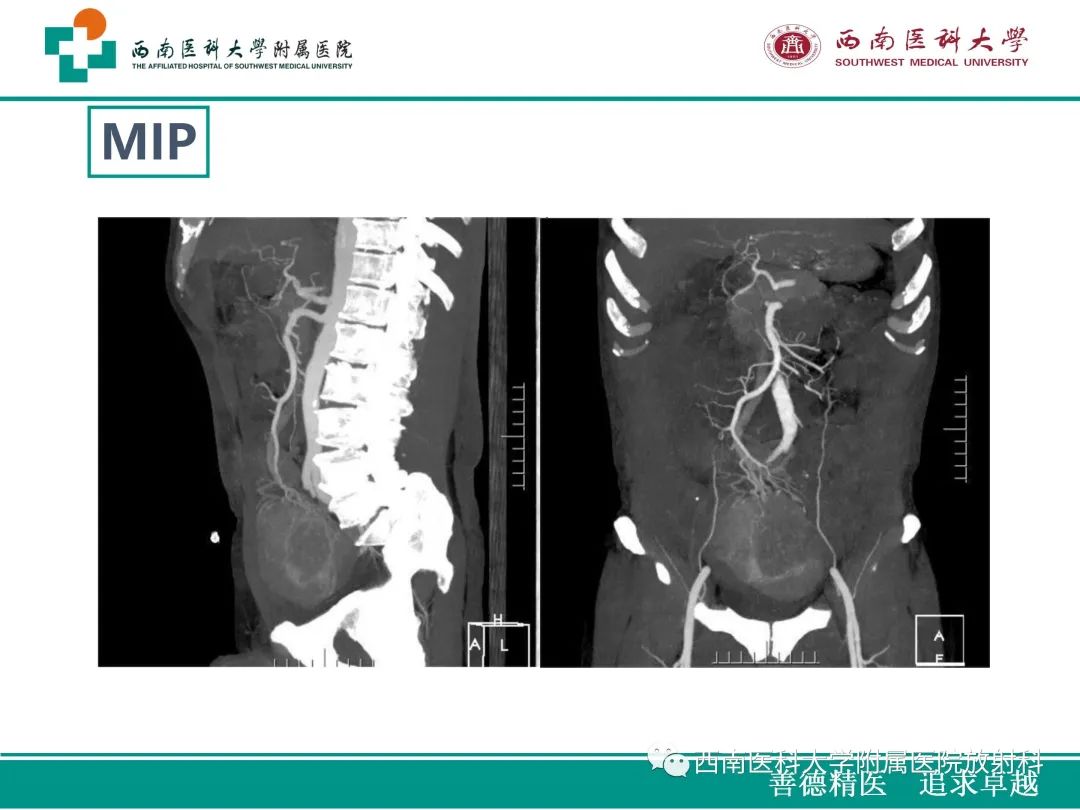 影像PPT - 【病例】原发性消化道恶性黑色素瘤1例CT影像-9
