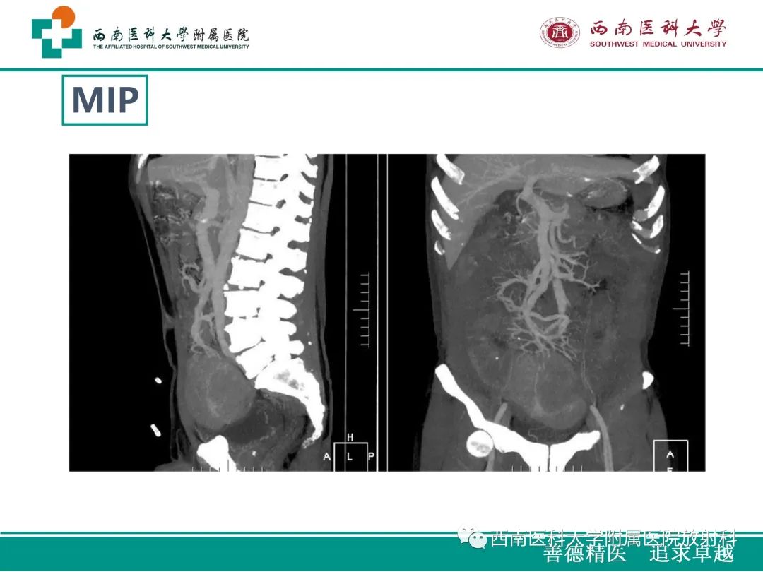 影像PPT - 【病例】原发性消化道恶性黑色素瘤1例CT影像-10