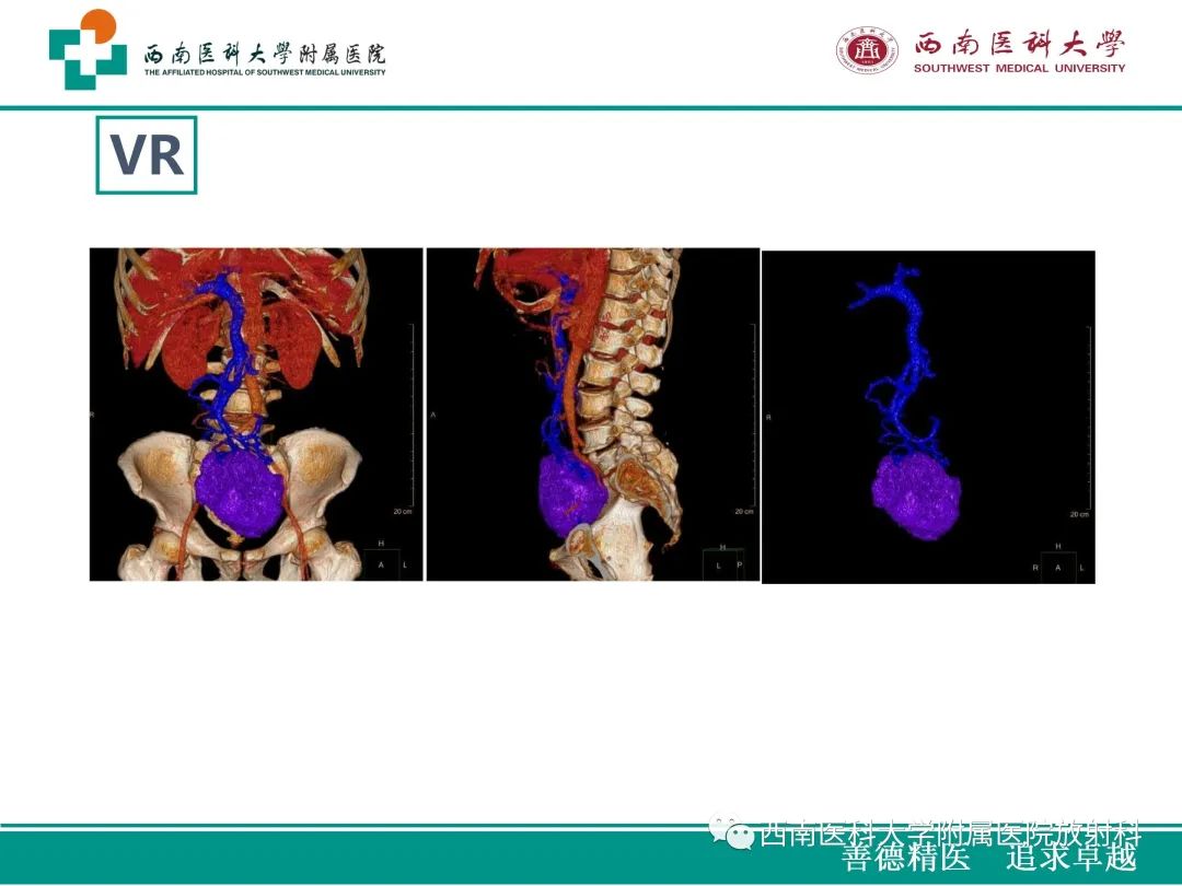 影像PPT - 【病例】原发性消化道恶性黑色素瘤1例CT影像-11