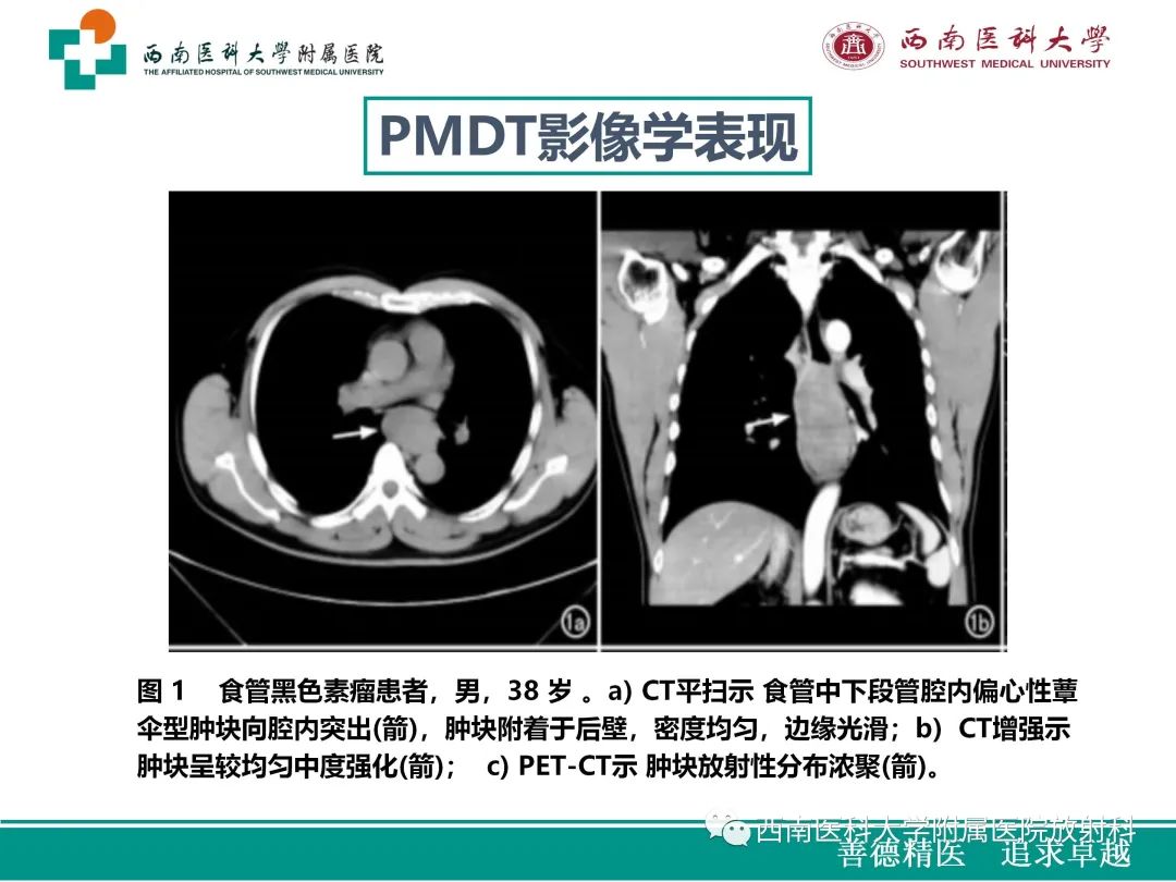 影像PPT - 【病例】原发性消化道恶性黑色素瘤1例CT影像-25
