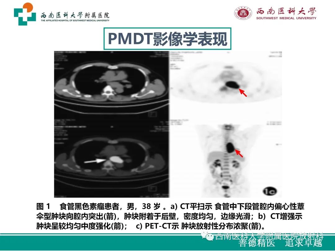 影像PPT - 【病例】原发性消化道恶性黑色素瘤1例CT影像-26