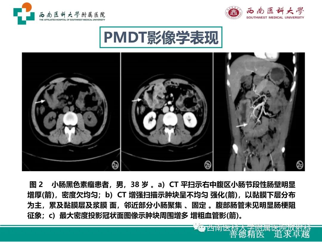 影像PPT - 【病例】原发性消化道恶性黑色素瘤1例CT影像-27