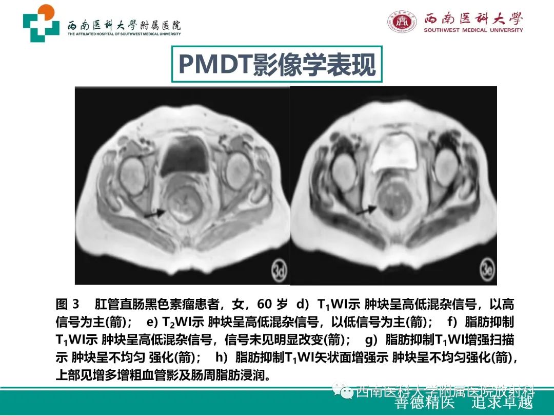 影像PPT - 【病例】原发性消化道恶性黑色素瘤1例CT影像-28