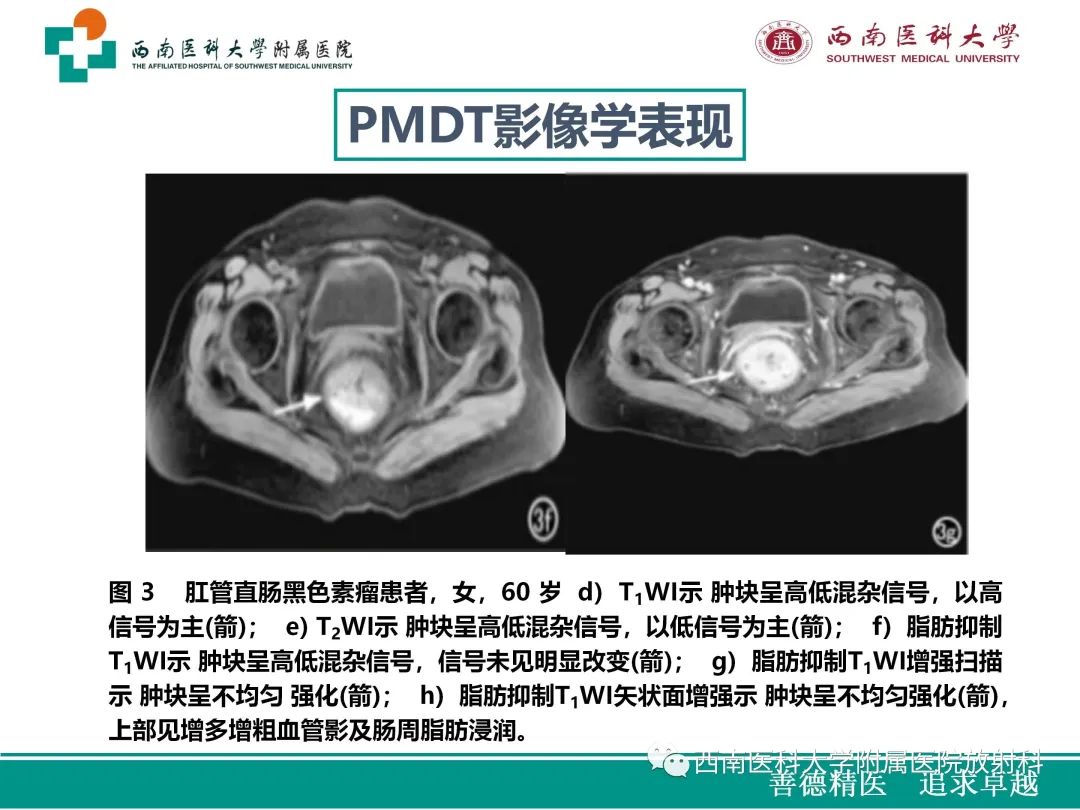 影像PPT - 【病例】原发性消化道恶性黑色素瘤1例CT影像-29