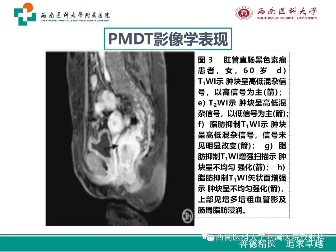 影像PPT - 【病例】原发性消化道恶性黑色素瘤1例CT影像-30