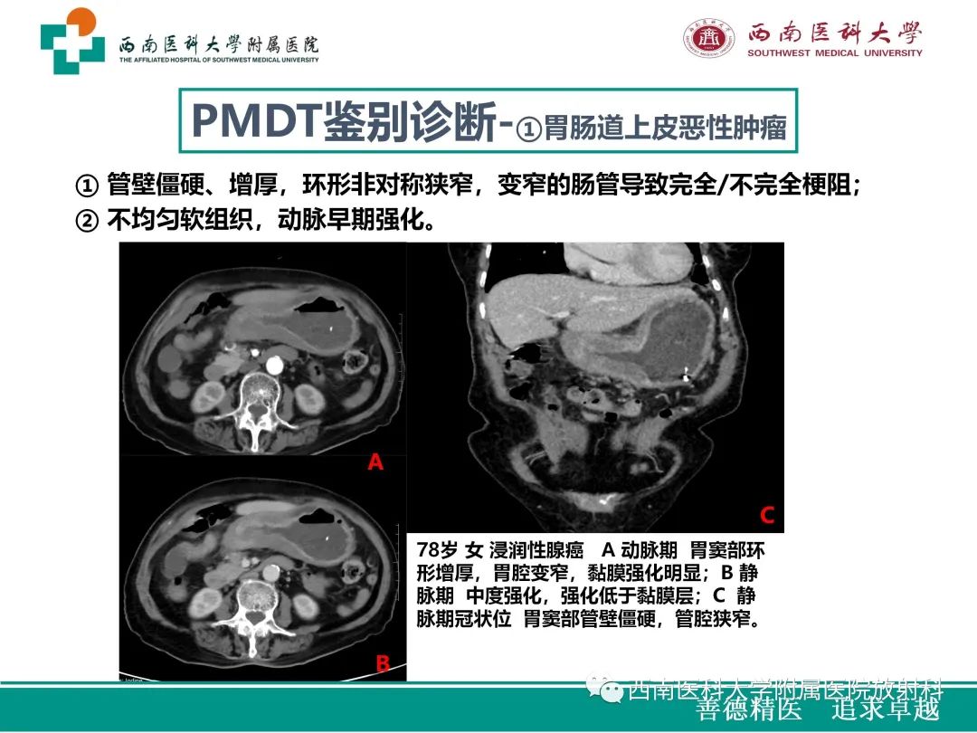 影像PPT - 【病例】原发性消化道恶性黑色素瘤1例CT影像-32