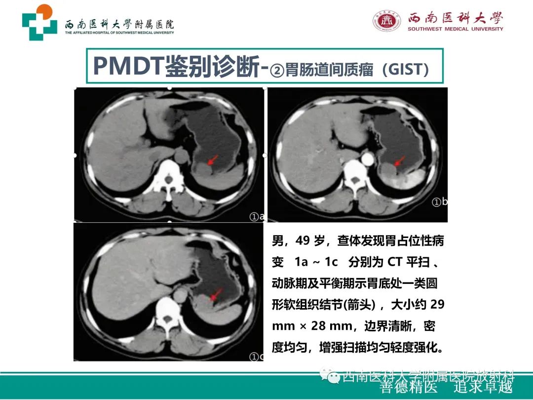 影像PPT - 【病例】原发性消化道恶性黑色素瘤1例CT影像-34