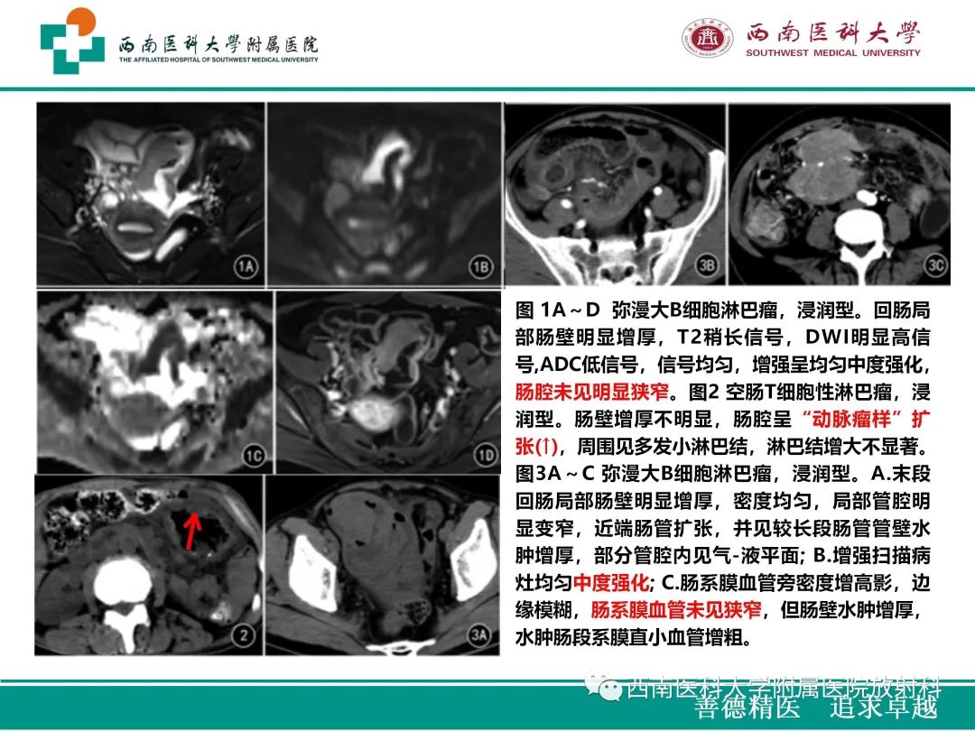 影像PPT - 【病例】原发性消化道恶性黑色素瘤1例CT影像-36