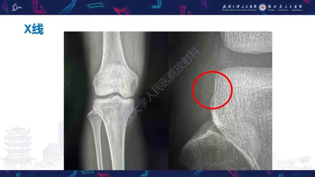 影像PPT - 【PPT】骨关节撕脱性损伤影像诊断-3