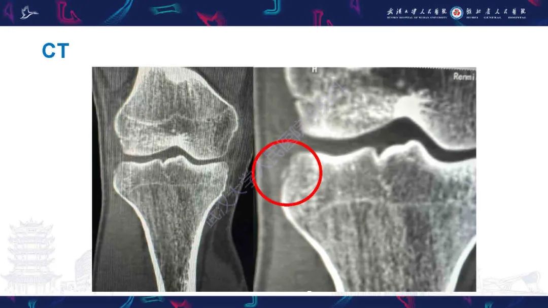 影像PPT - 【PPT】骨关节撕脱性损伤影像诊断-4