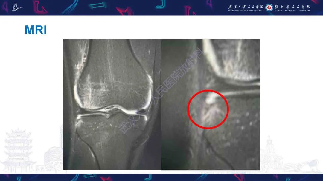 影像PPT - 【PPT】骨关节撕脱性损伤影像诊断-5