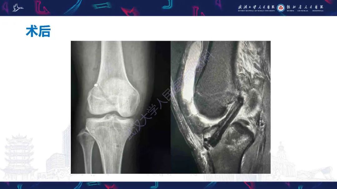 影像PPT - 【PPT】骨关节撕脱性损伤影像诊断-8