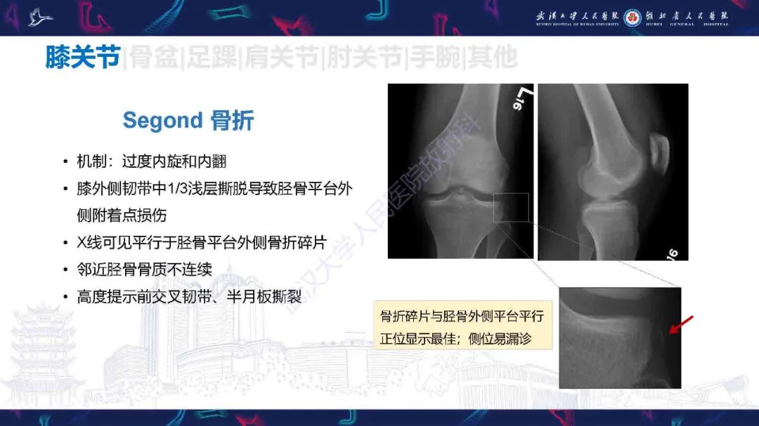 影像PPT - 【PPT】骨关节撕脱性损伤影像诊断-13
