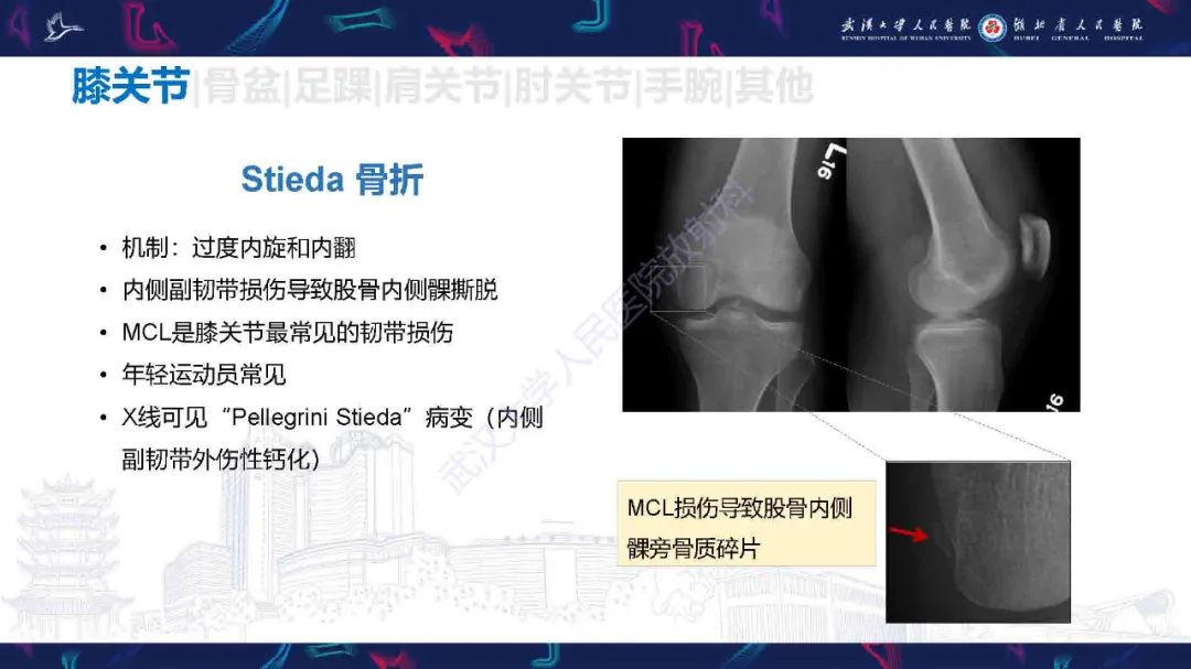 影像PPT - 【PPT】骨关节撕脱性损伤影像诊断-14