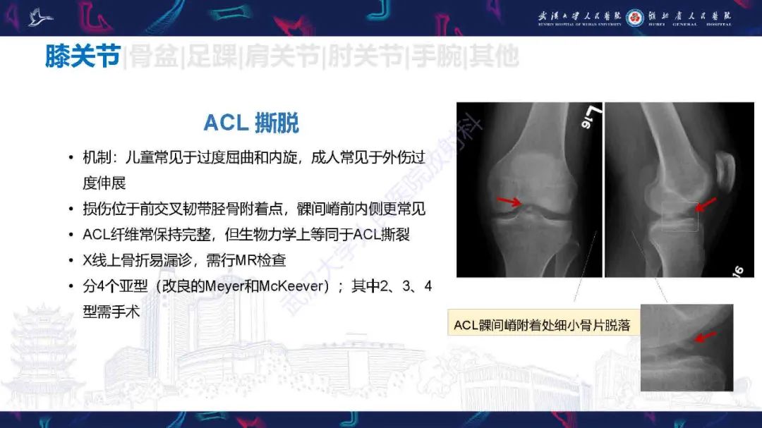 影像PPT - 【PPT】骨关节撕脱性损伤影像诊断-15