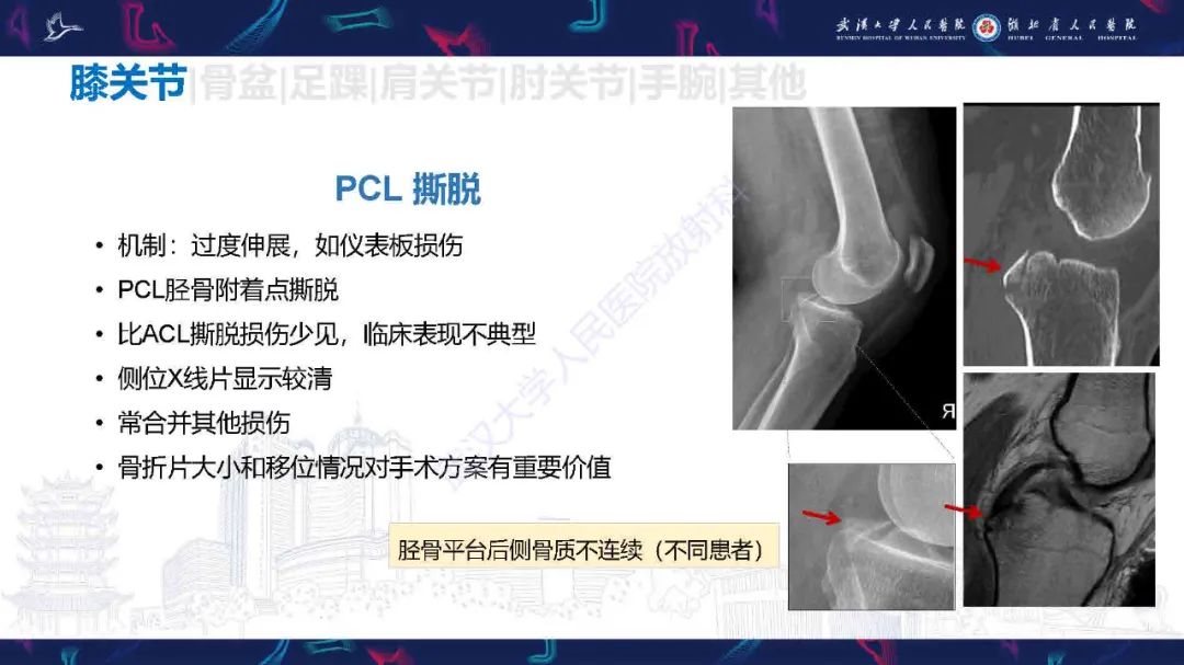 影像PPT - 【PPT】骨关节撕脱性损伤影像诊断-16