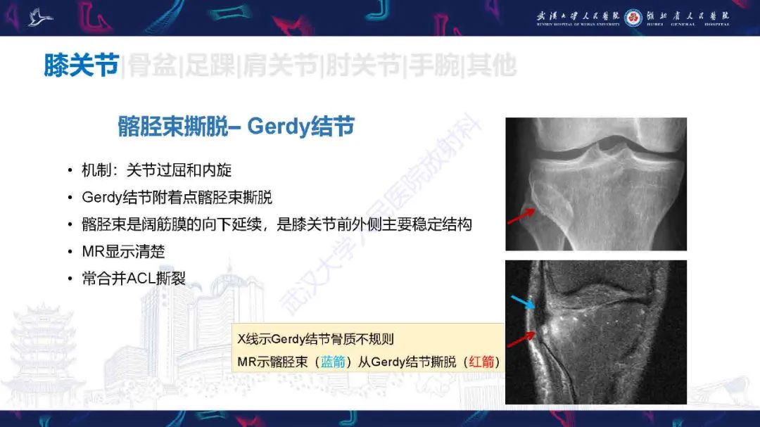 影像PPT - 【PPT】骨关节撕脱性损伤影像诊断-17