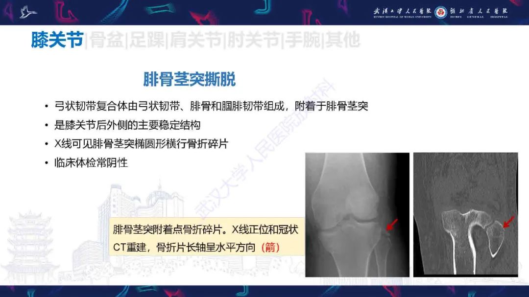 影像PPT - 【PPT】骨关节撕脱性损伤影像诊断-18