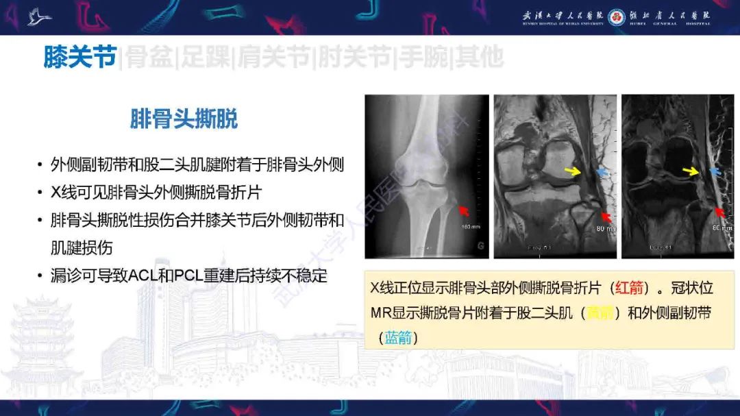 影像PPT - 【PPT】骨关节撕脱性损伤影像诊断-19