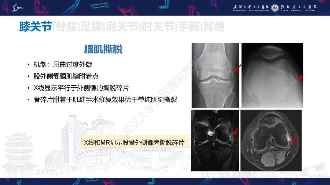 影像PPT - 【PPT】骨关节撕脱性损伤影像诊断-20