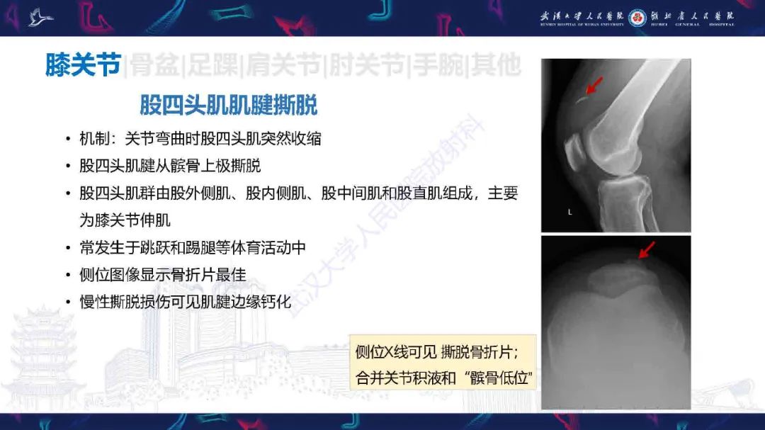 影像PPT - 【PPT】骨关节撕脱性损伤影像诊断-21