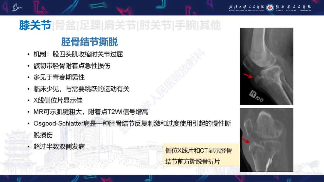 影像PPT - 【PPT】骨关节撕脱性损伤影像诊断-22