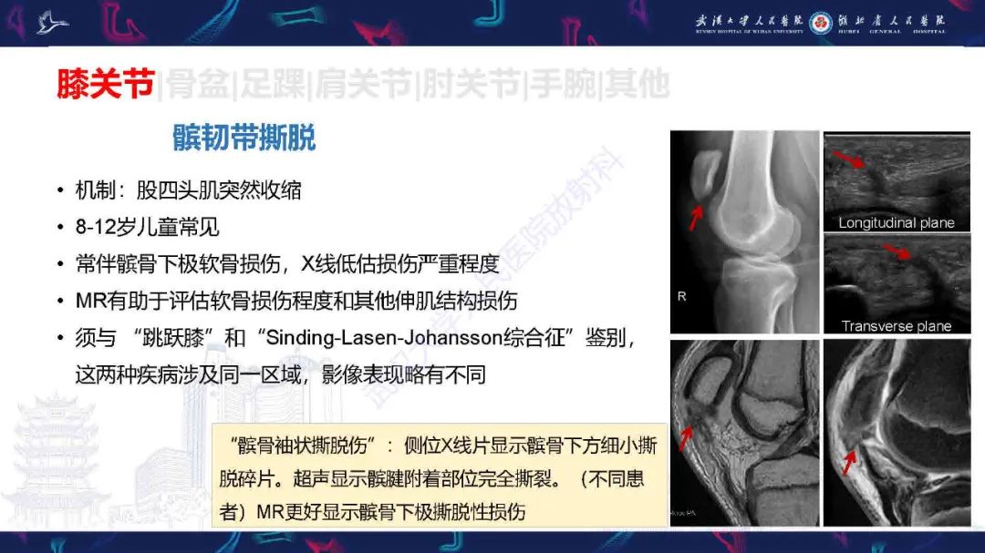 影像PPT - 【PPT】骨关节撕脱性损伤影像诊断-23