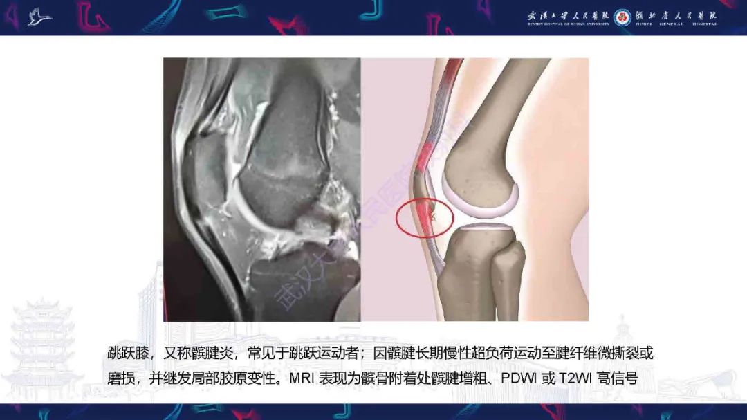 影像PPT - 【PPT】骨关节撕脱性损伤影像诊断-24