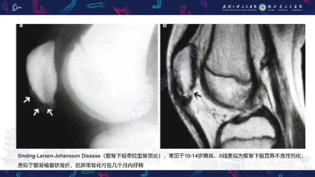 影像PPT - 【PPT】骨关节撕脱性损伤影像诊断-25