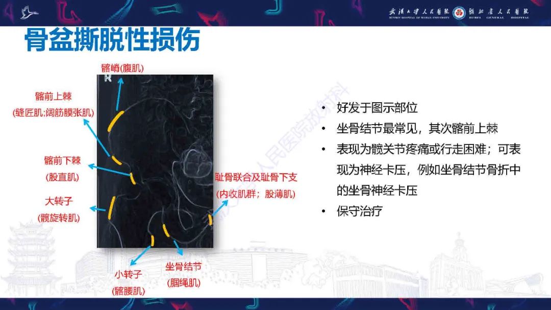 影像PPT - 【PPT】骨关节撕脱性损伤影像诊断-26