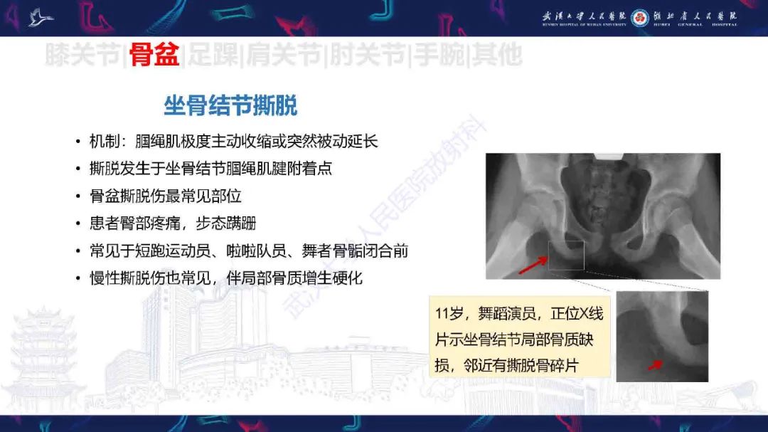 影像PPT - 【PPT】骨关节撕脱性损伤影像诊断-27