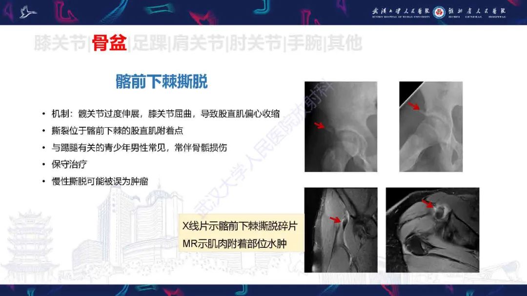 影像PPT - 【PPT】骨关节撕脱性损伤影像诊断-28