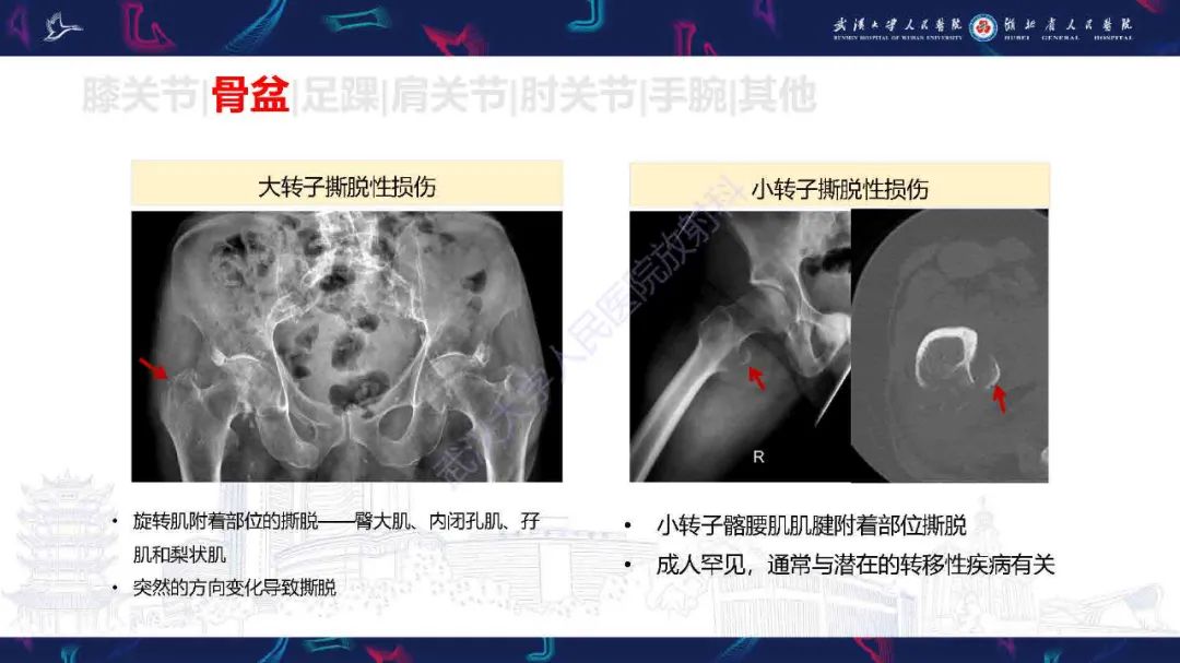 影像PPT - 【PPT】骨关节撕脱性损伤影像诊断-29