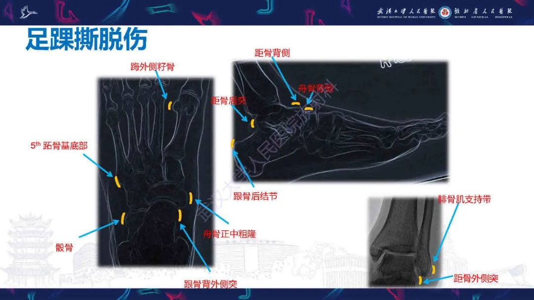 影像PPT - 【PPT】骨关节撕脱性损伤影像诊断-30