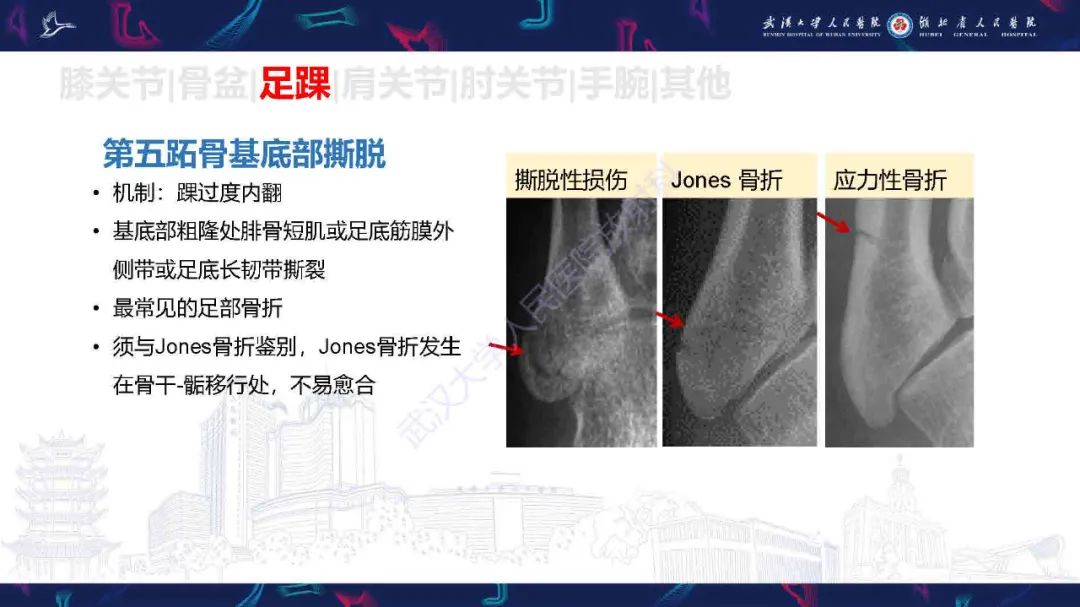 影像PPT - 【PPT】骨关节撕脱性损伤影像诊断-31