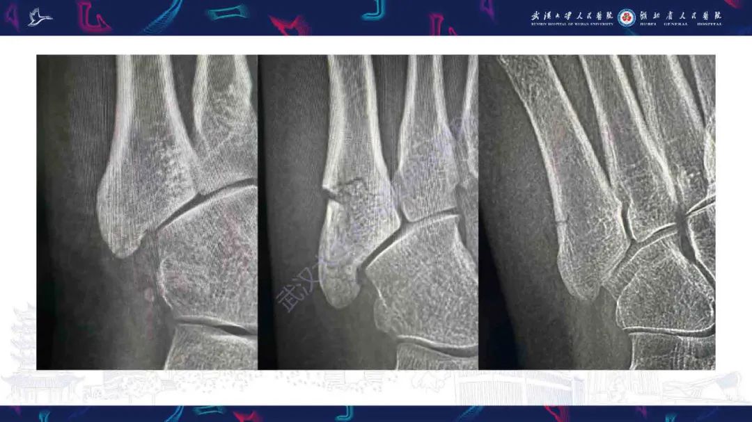 影像PPT - 【PPT】骨关节撕脱性损伤影像诊断-33