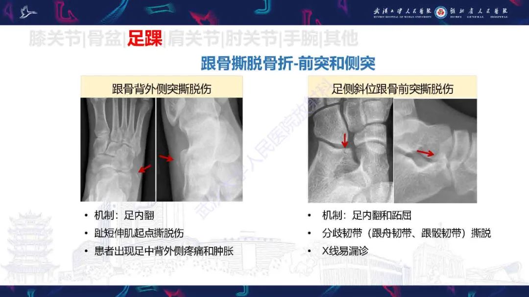影像PPT - 【PPT】骨关节撕脱性损伤影像诊断-34