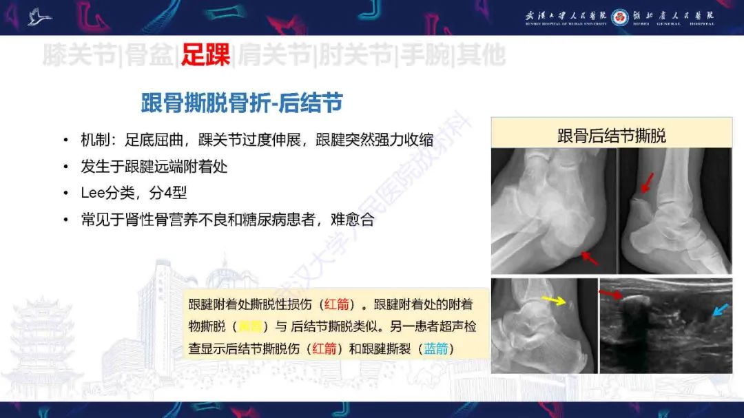影像PPT - 【PPT】骨关节撕脱性损伤影像诊断-35