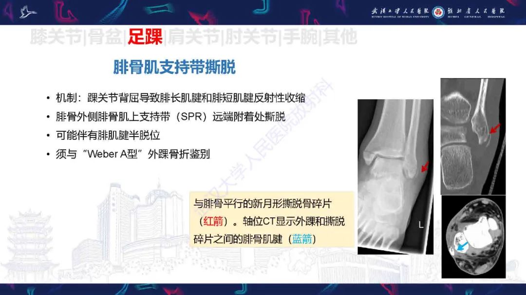 影像PPT - 【PPT】骨关节撕脱性损伤影像诊断-36