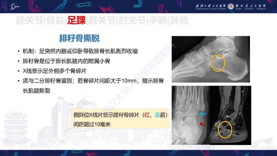 影像PPT - 【PPT】骨关节撕脱性损伤影像诊断-37