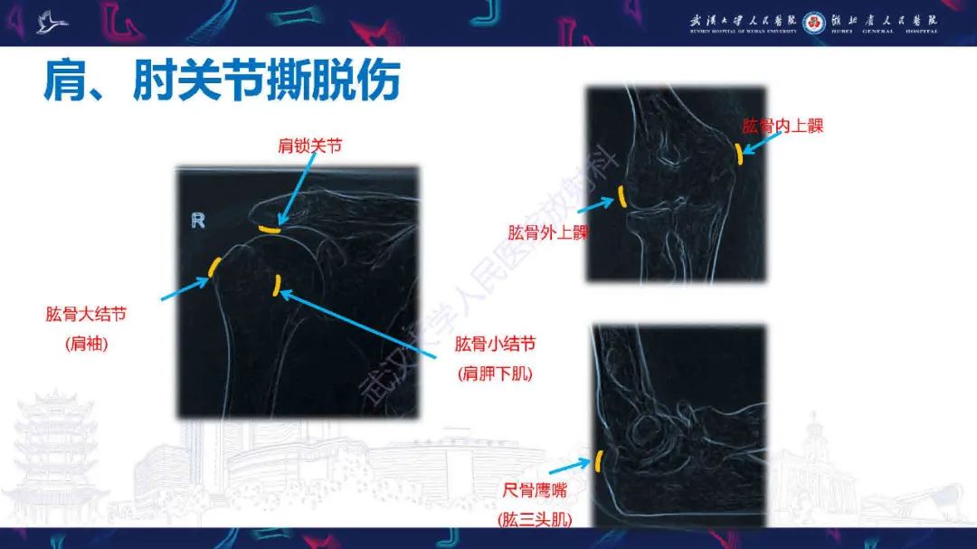 影像PPT - 【PPT】骨关节撕脱性损伤影像诊断-38