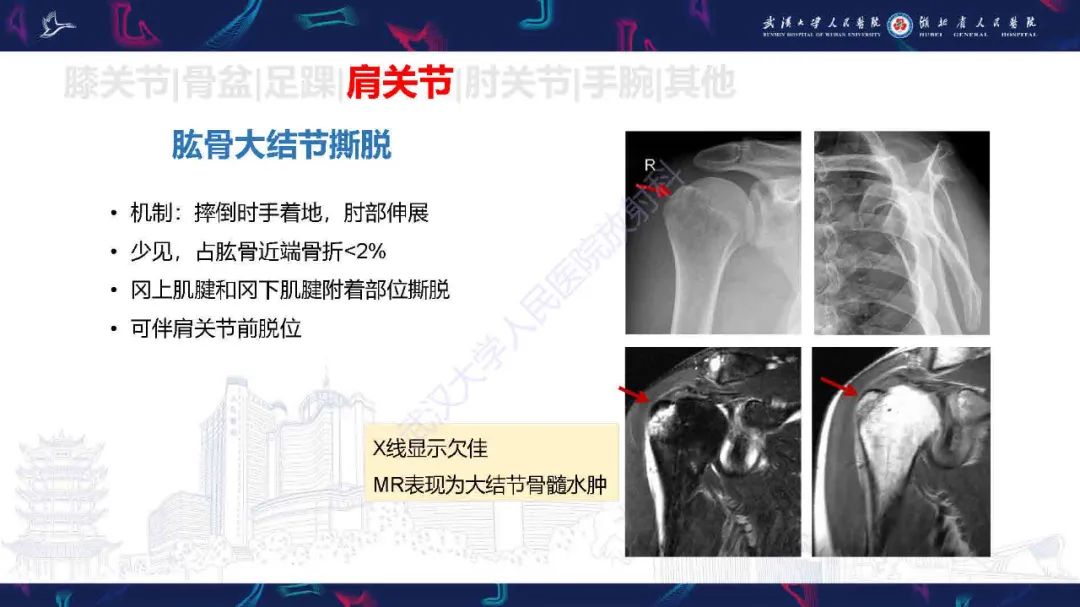 影像PPT - 【PPT】骨关节撕脱性损伤影像诊断-39