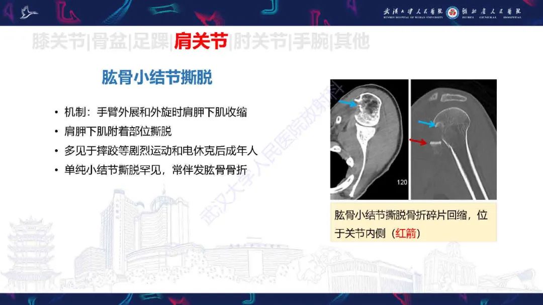 影像PPT - 【PPT】骨关节撕脱性损伤影像诊断-40